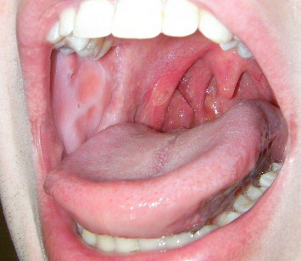 Волдыри в горле Волдыри в горле