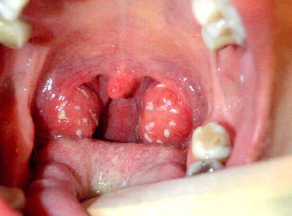 Волдыри в горле Волдыри в горле