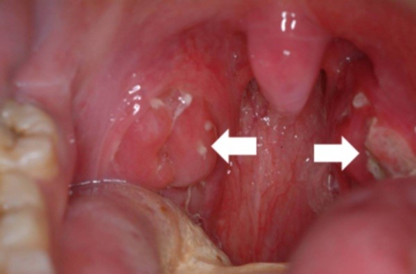 Волдыри в горле Волдыри в горле
