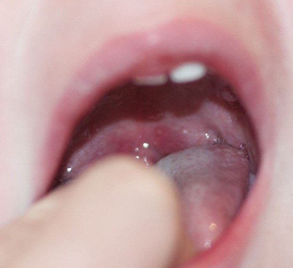 Волдыри в горле Волдыри в горле