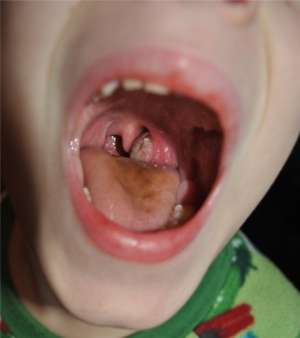 Волдыри в горле Волдыри в горле