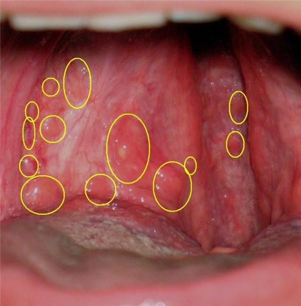 Волдыри в горле Волдыри в горле