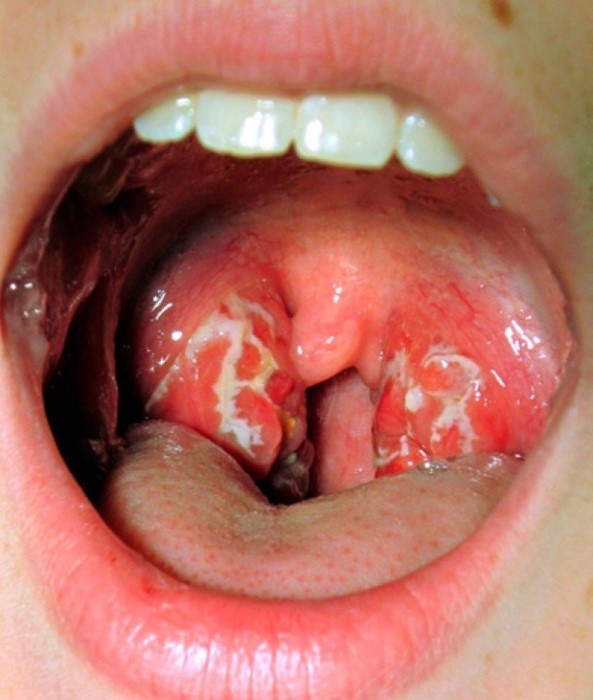 Волдыри в горле Волдыри в горле