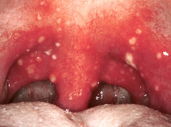 Волдыри в горле Волдыри в горле