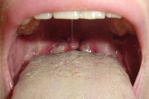 Волдыри в горле Волдыри в горле