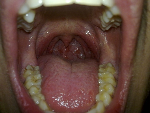 Волдыри в горле Волдыри в горле