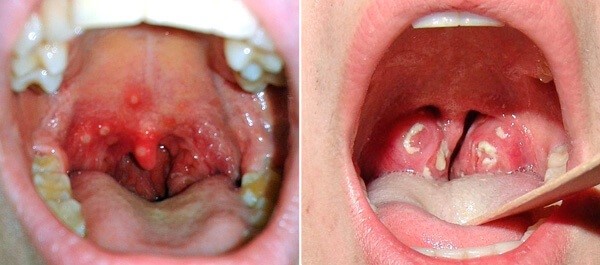 Волдыри в горле Волдыри в горле