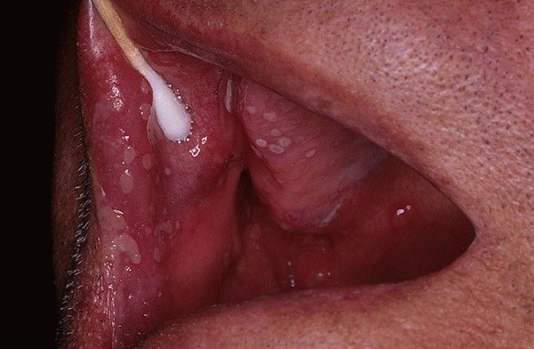 Волдыри в горле Волдыри в горле