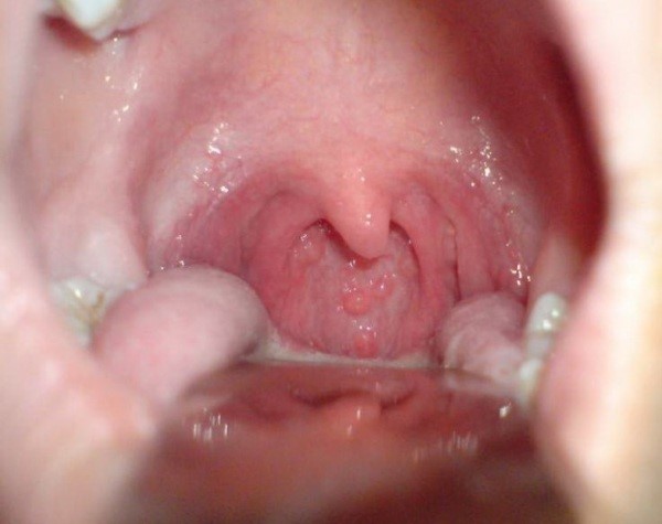 Волдыри в горле Волдыри в горле