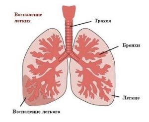 Основные симптомы воспаления легких у взрослых Основные симптомы воспаления легких у взрослых