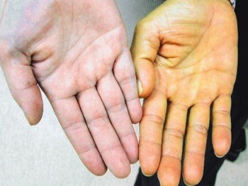 Заразна ли механическая желтуха Заразна ли механическая желтуха