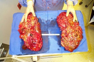 Классификация хронической болезни почек Классификация хронической болезни почек