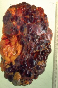 Классификация хронической болезни почек Классификация хронической болезни почек