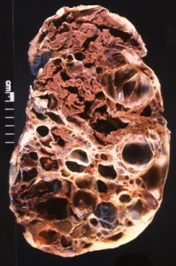 Классификация хронической болезни почек Классификация хронической болезни почек