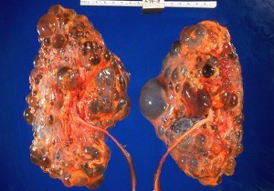 Классификация хронической болезни почек Классификация хронической болезни почек