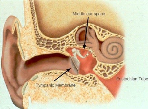 Хронический отит Хронический отит