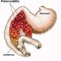 Хронический панкреатит: возможное лечение народными средствами Хронический панкреатит: возможное лечение народными средствами