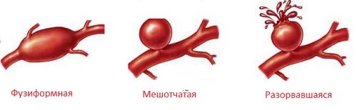 Болезни сосудов головного мозга Болезни сосудов головного мозга