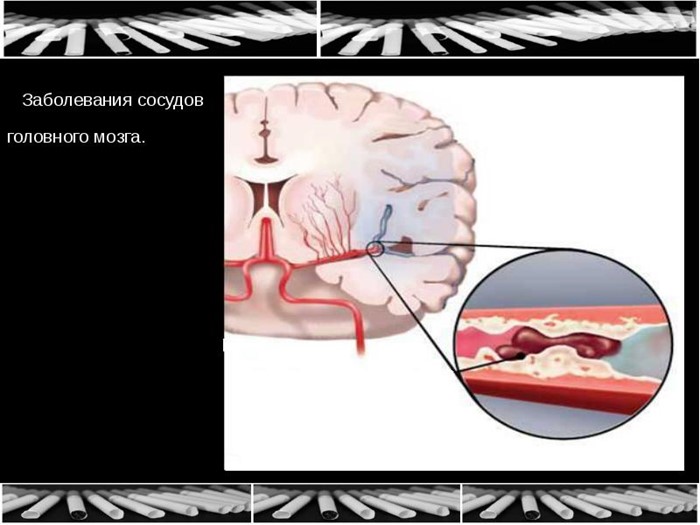 Болезни сосудов головного мозга Болезни сосудов головного мозга