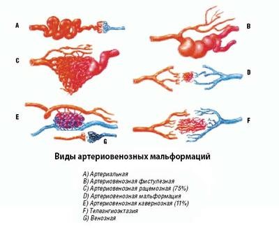 Болезни сосудов головного мозга Болезни сосудов головного мозга