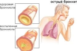 Можно ли считать бронхит заразным? Можно ли считать бронхит заразным?