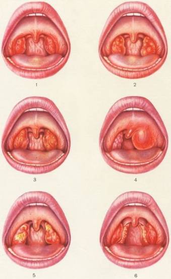Заразна ли гнойная ангина Заразна ли гнойная ангина