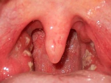 Заразна ли гнойная ангина Заразна ли гнойная ангина