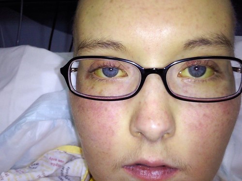 Симптомы холестаза - застоя желчи в желчном пузыре Симптомы холестаза - застоя желчи в желчном пузыре