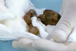 Основные симптомы приступа желчнокаменной болезни Основные симптомы приступа желчнокаменной болезни