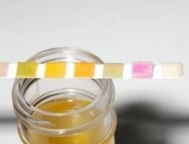 Анализ мочи при пиелонефрите: цвет, показатели Анализ мочи при пиелонефрите: цвет, показатели