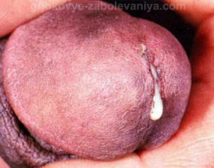 Жжение в заднем проходе: лечение Жжение в заднем проходе: лечение