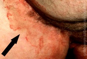 Жжение в заднем проходе: лечение Жжение в заднем проходе: лечение